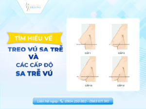 Treo vú sa trễ